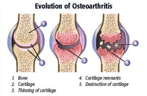 Evolution of Osteoarthritis